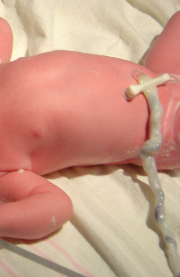 Figura: Cordão Umbilical em RN 